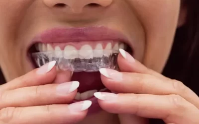 Invisalign Charlotte: Clear Aligner Therapy for Discreet Orthodontic Correction